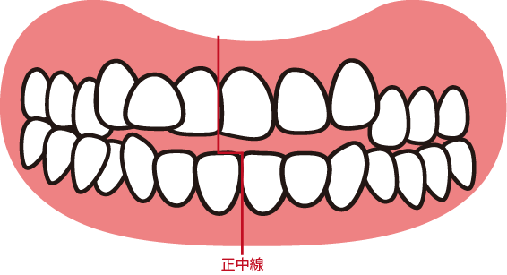 歯並びについて（顎変形症）かみ合わせシリーズ⑪