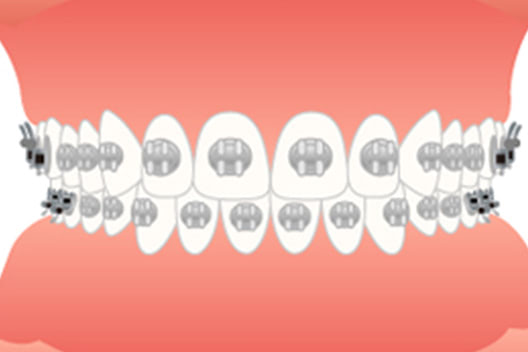 歯列矯正の種類について